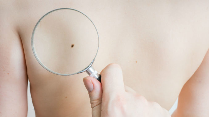FDA Approves New Melanoma Treatment FDA Approves New Melanoma Treatment