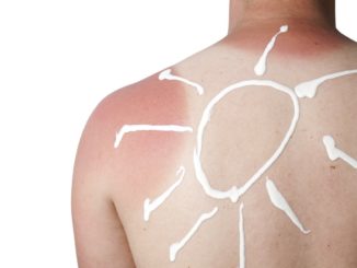melanoma-risks-and-free-screening