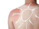 melanoma-risks-and-free-screening